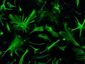 Investigadores de la UMA e IBIMA identifican astrocitos senescentes en cerebros con alzhéimer